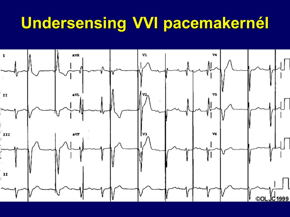 Undersensing VVI pacemakernél