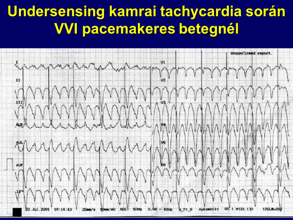 Undersensing kamrai tachycardia során VVI pacemakeres betegnél