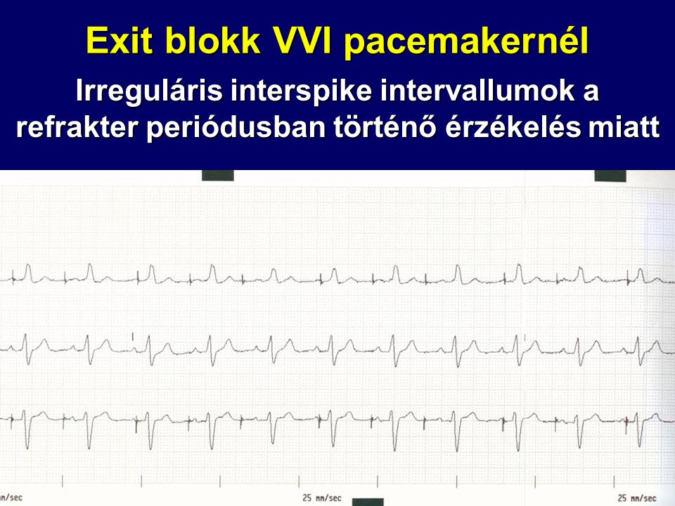 Exit blokk VVI pacemakernél