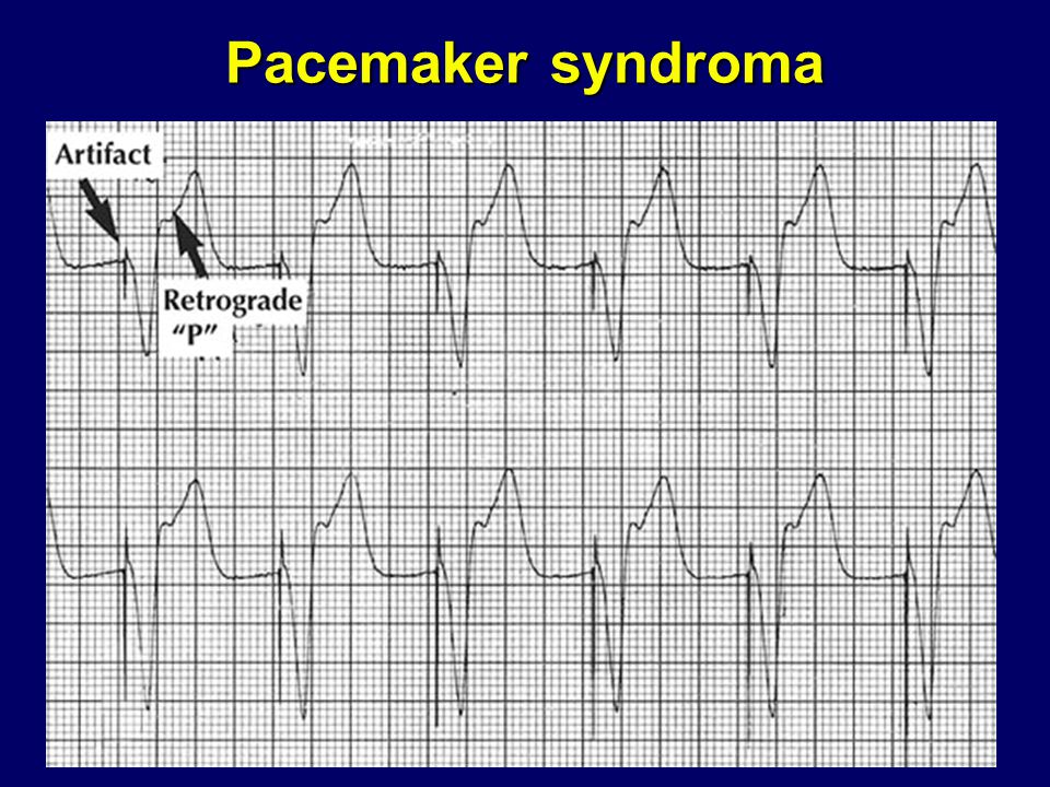 Pacemaker syndroma