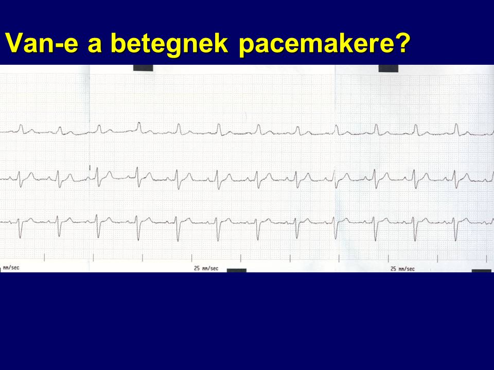 Van-e a betegnek pacemakere