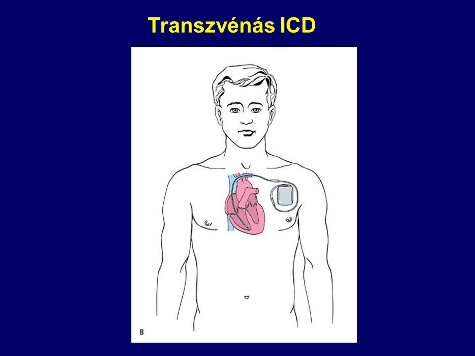 Transzvénás ICD