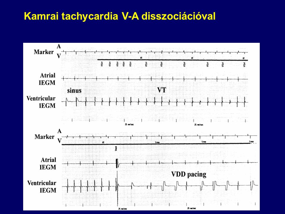 Kamrai tachycardia V-A disszociációval