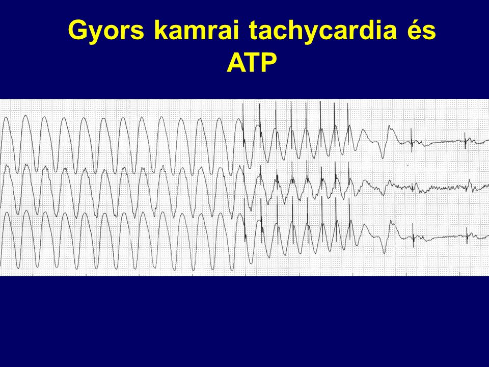 Gyors kamrai tachycardia és ATP