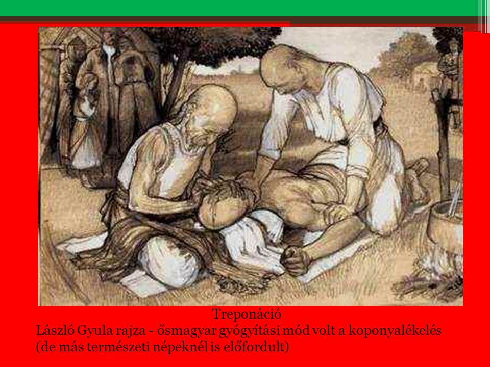Treponáció László Gyula rajza - ősmagyar gyógyítási mód volt a koponyalékelés (de más természeti népeknél is előfordult)