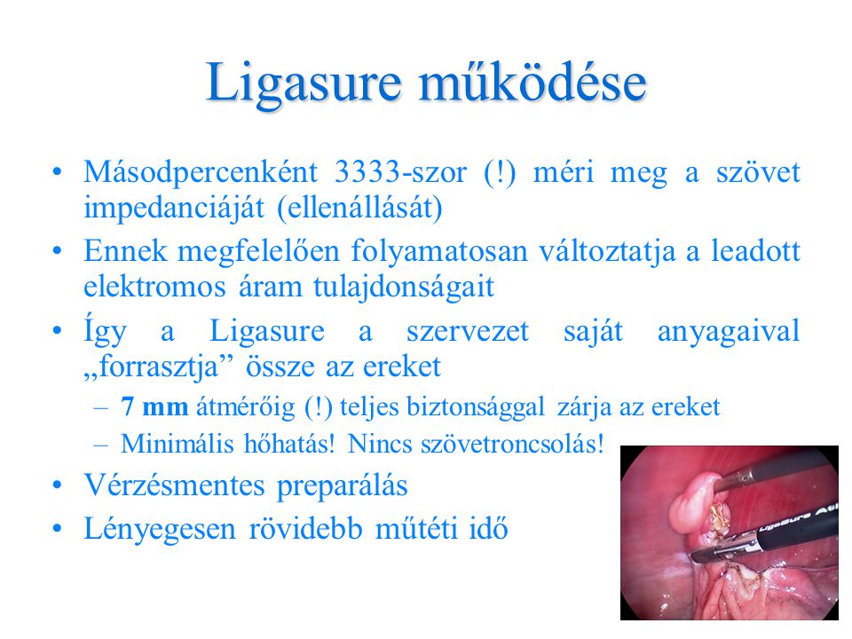 Ligasure működése Másodpercenként 3333-szor (!) méri meg a szövet impedanciáját (ellenállását)