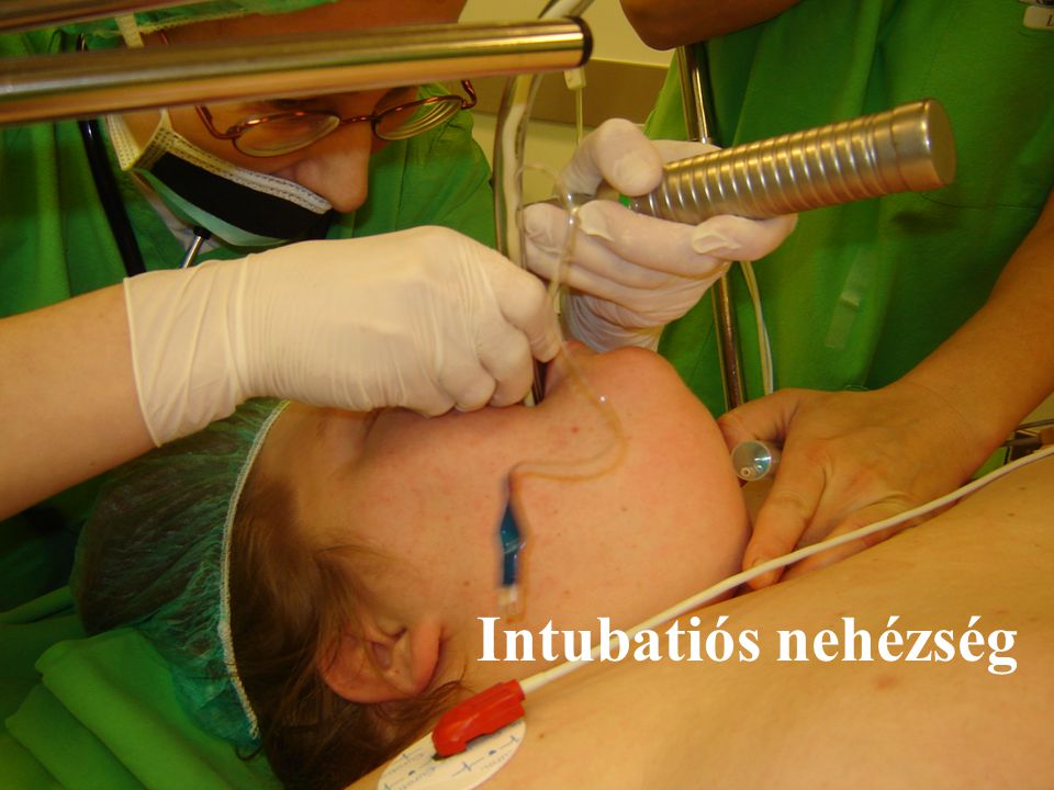 Intubatiós nehézség