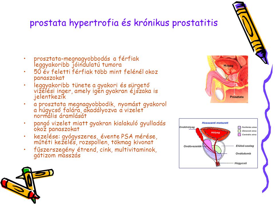 Krónikus prosztatitis étrend kezelése