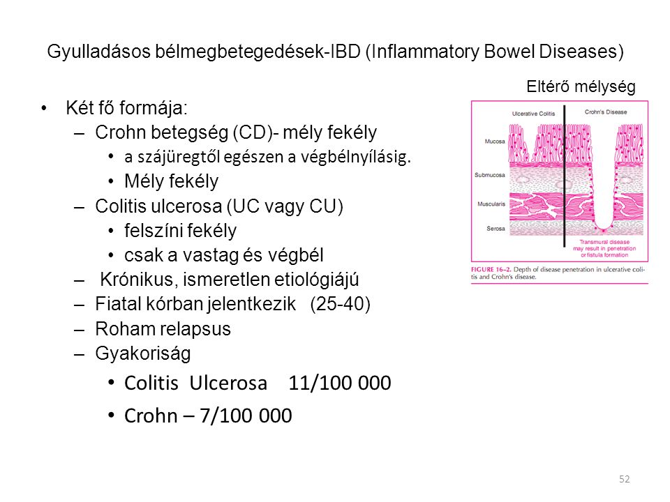 Gyulladásos bélmegbetegedések-IBD (Inflammatory Bowel Diseases)