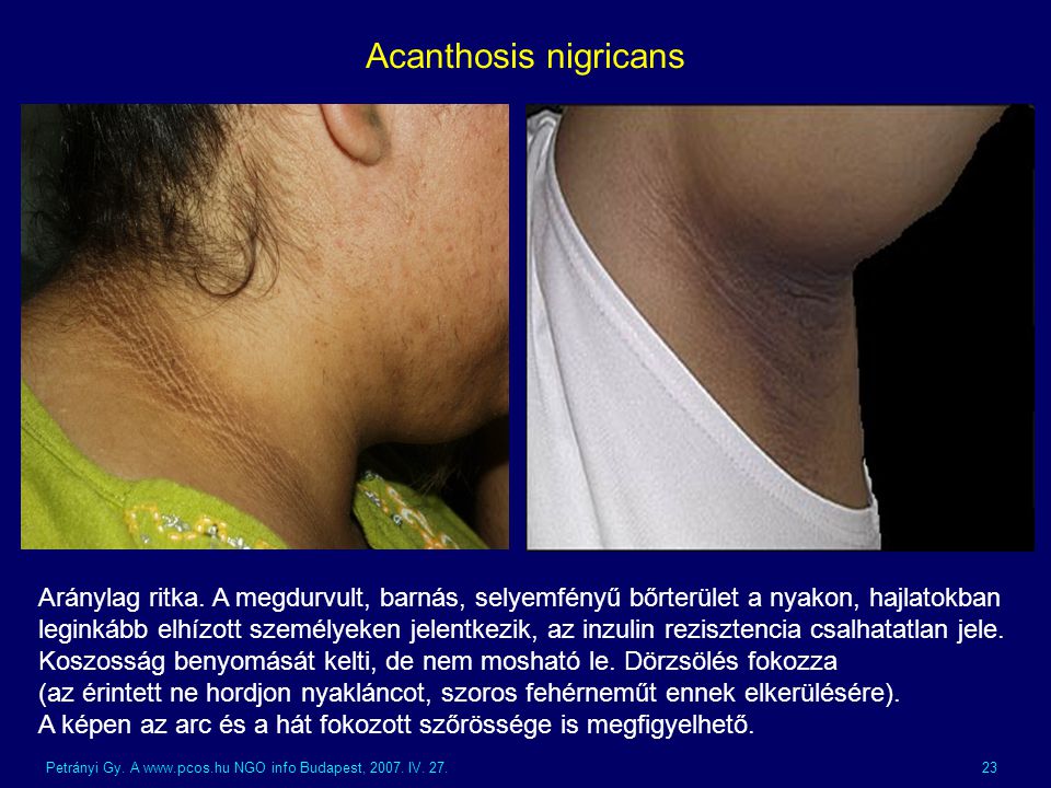Acanthosis nigricans Aránylag ritka. A megdurvult, barnás, selyemfényű bőrterület a nyakon, hajlatokban.