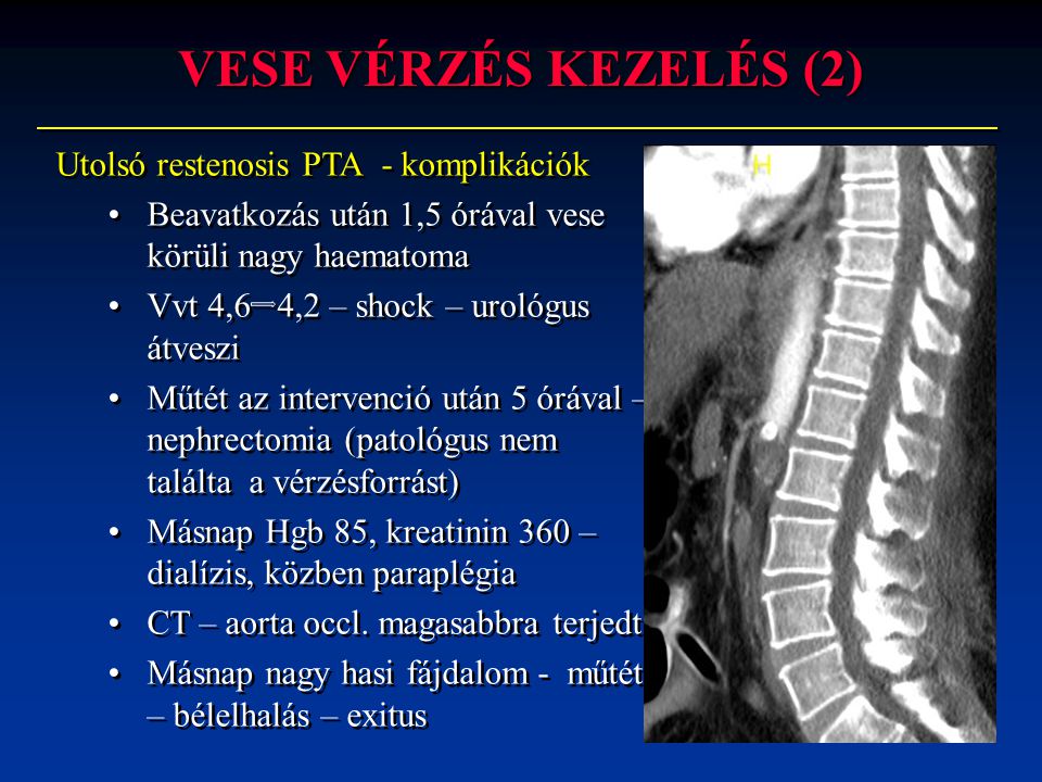 VESE VÉRZÉS KEZELÉS (2) Utolsó restenosis PTA - komplikációk