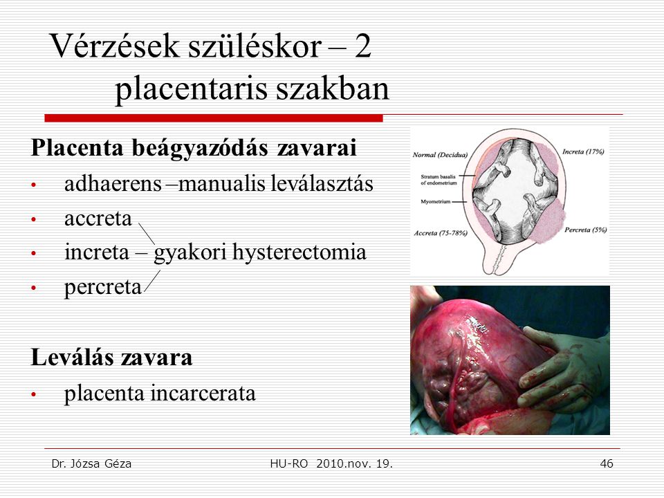Vérzések szüléskor – 2 placentaris szakban