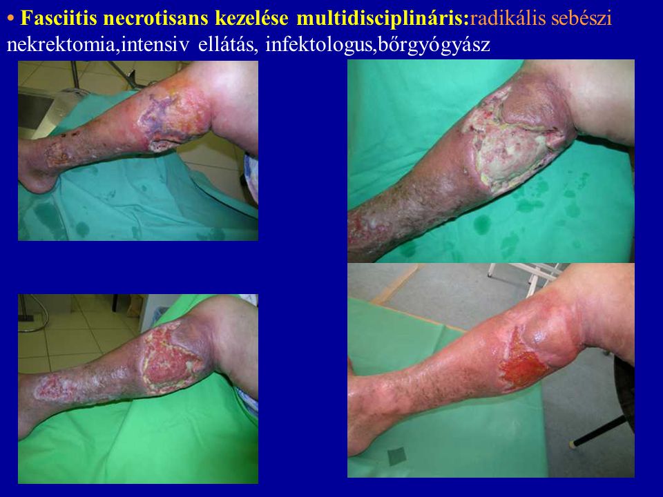 • Fasciitis necrotisans kezelése multidisciplináris:radikális sebészi