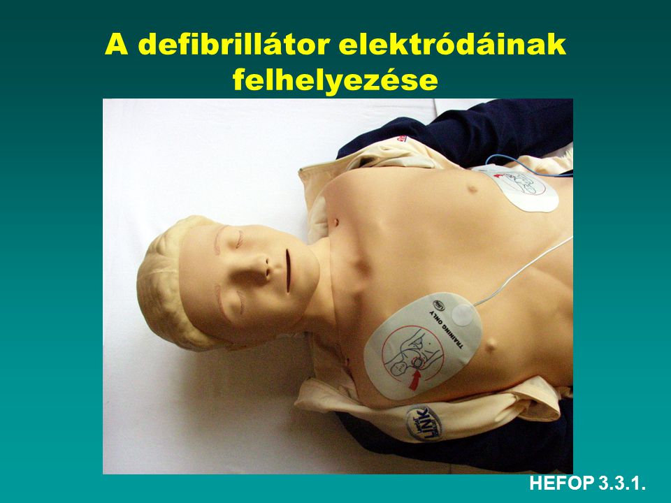 A defibrillátor elektródáinak felhelyezése