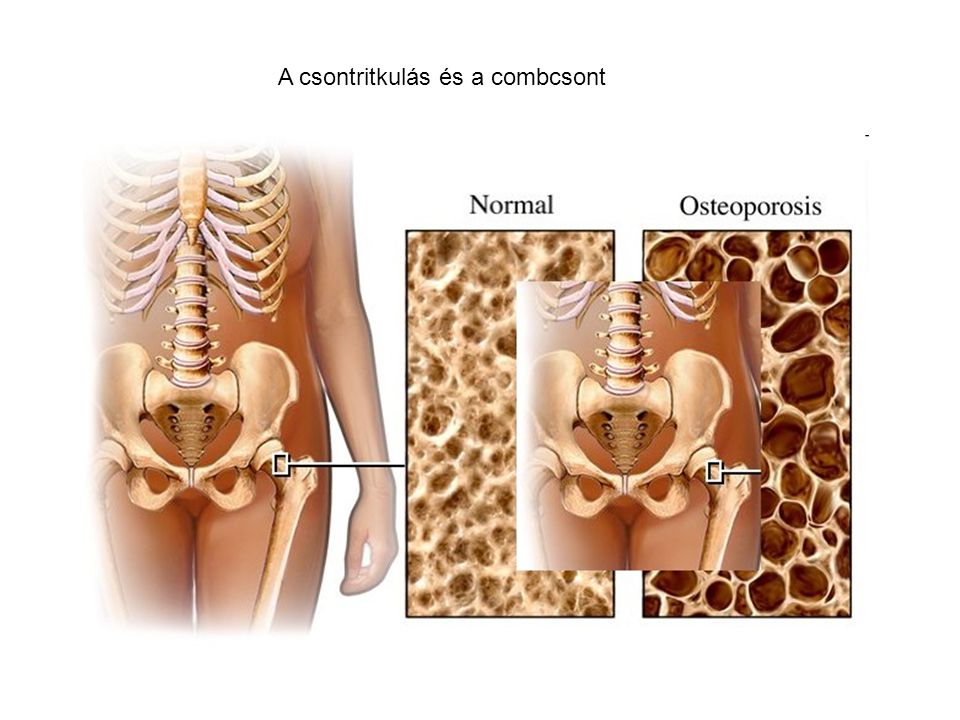 A csontritkulás és a combcsont
