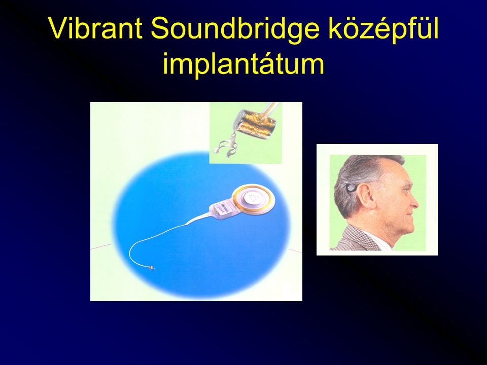 Vibrant Soundbridge középfül implantátum