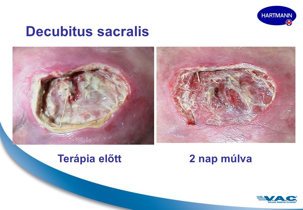 Decubitus sacralis Terápia előtt 2 nap múlva
