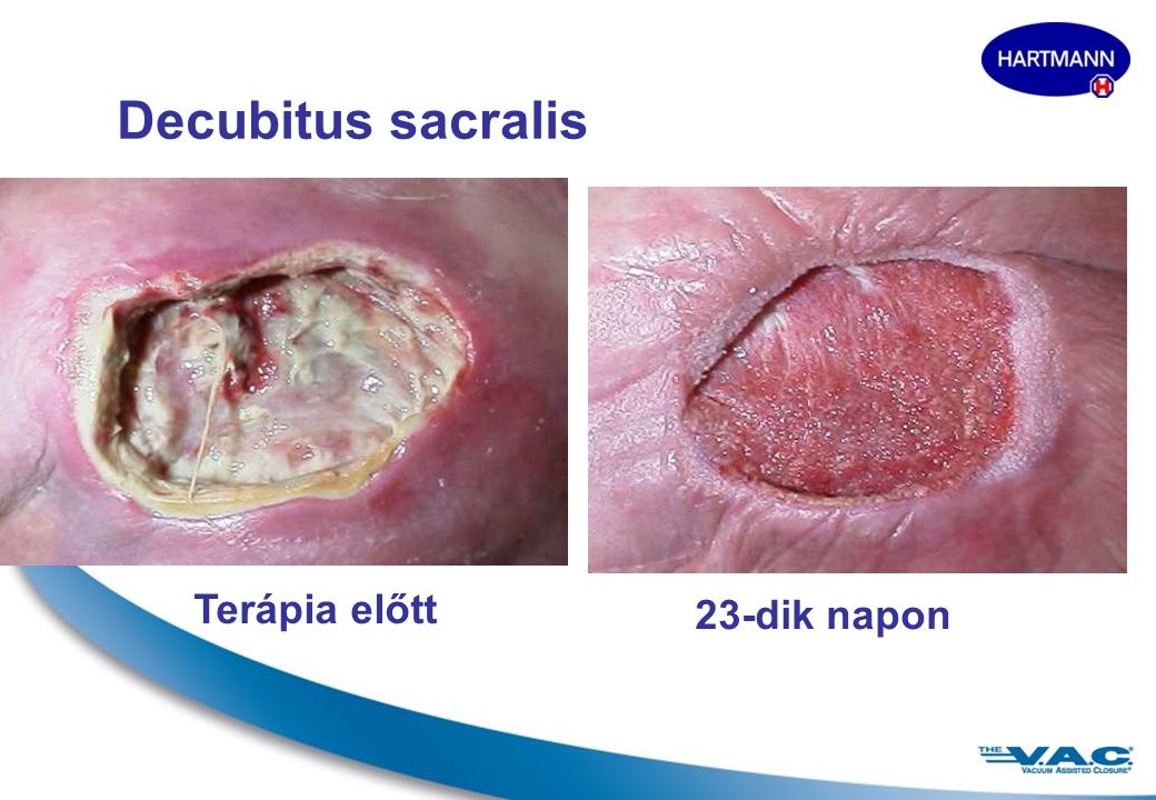 Decubitus sacralis Terápia előtt 23-dik napon