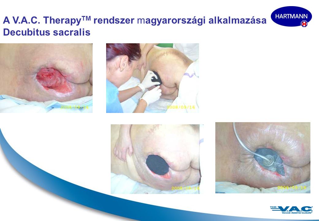 A V.A.C. TherapyTM rendszer magyarországi alkalmazása