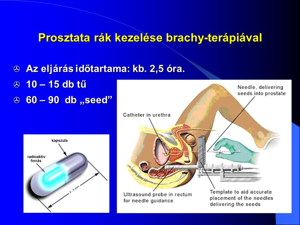 Prostatitis brachyterápia után)