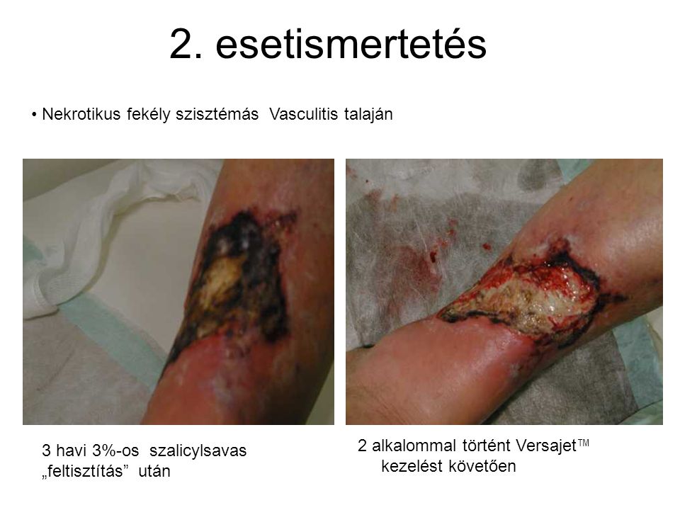 2. esetismertetés Nekrotikus fekély szisztémás Vasculitis talaján