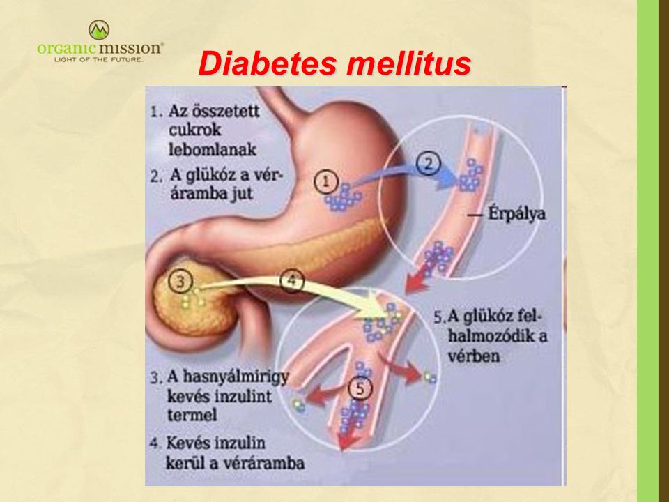 A cystitis diabetes mellitus tünetei