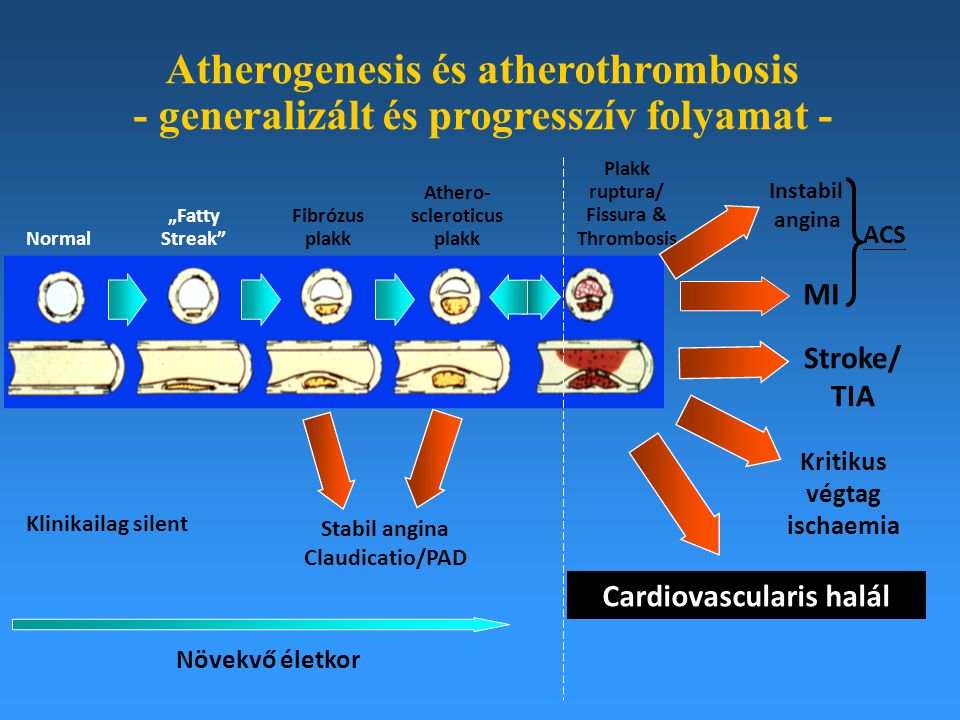 Atherogenesis és atherothrombosis - generalizált és progresszív folyamat -
