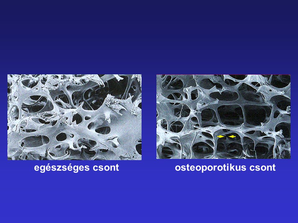 egészséges csont osteoporotikus csont