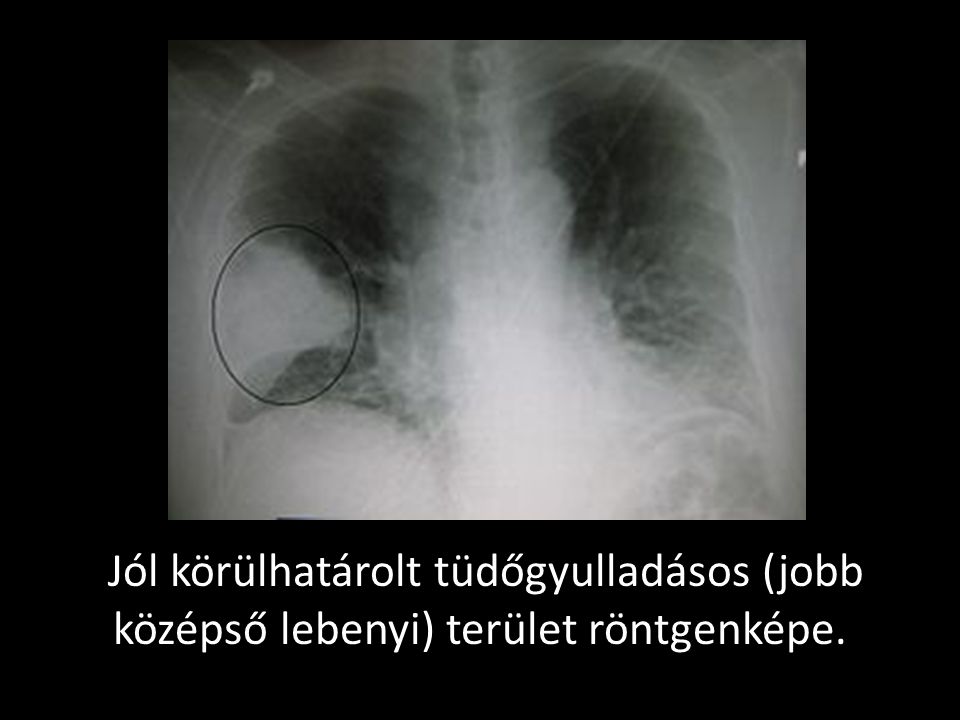 Jól körülhatárolt tüdőgyulladásos (jobb középső lebenyi) terület röntgenképe.