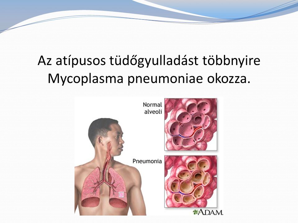 Az atípusos tüdőgyulladást többnyire Mycoplasma pneumoniae okozza.