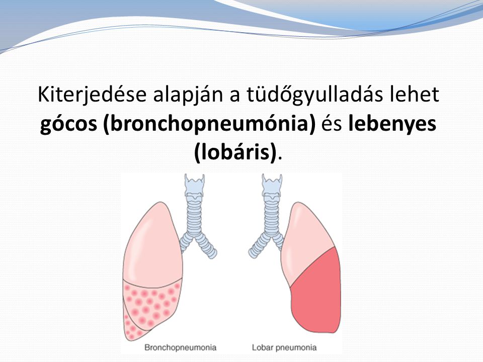 Kiterjedése alapján a tüdőgyulladás lehet gócos (bronchopneumónia) és lebenyes (lobáris).