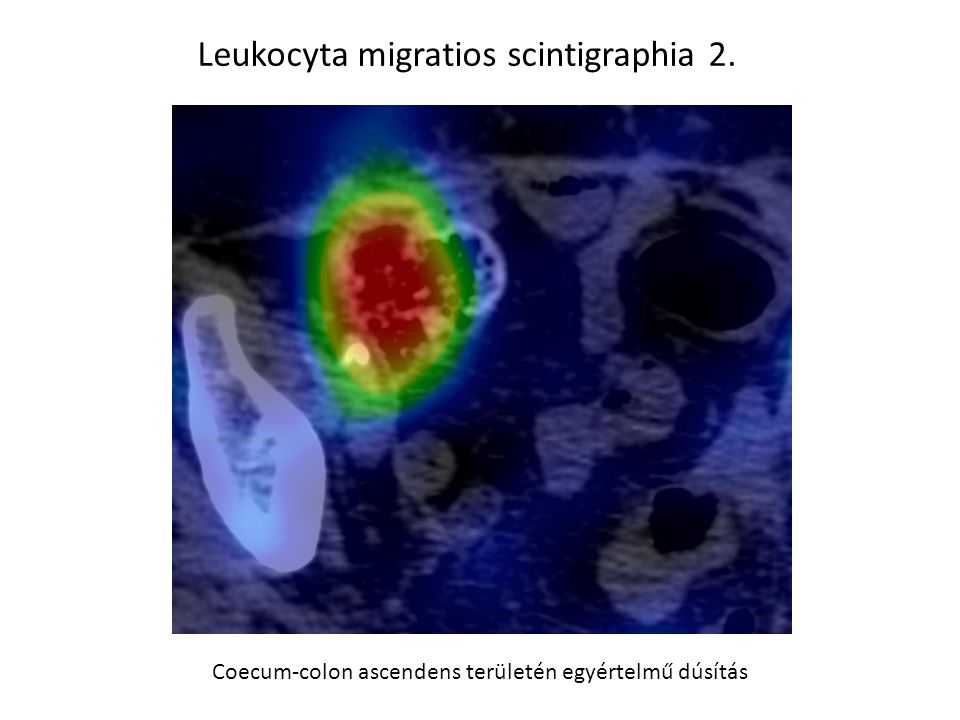 Leukocyta migratios scintigraphia 2.