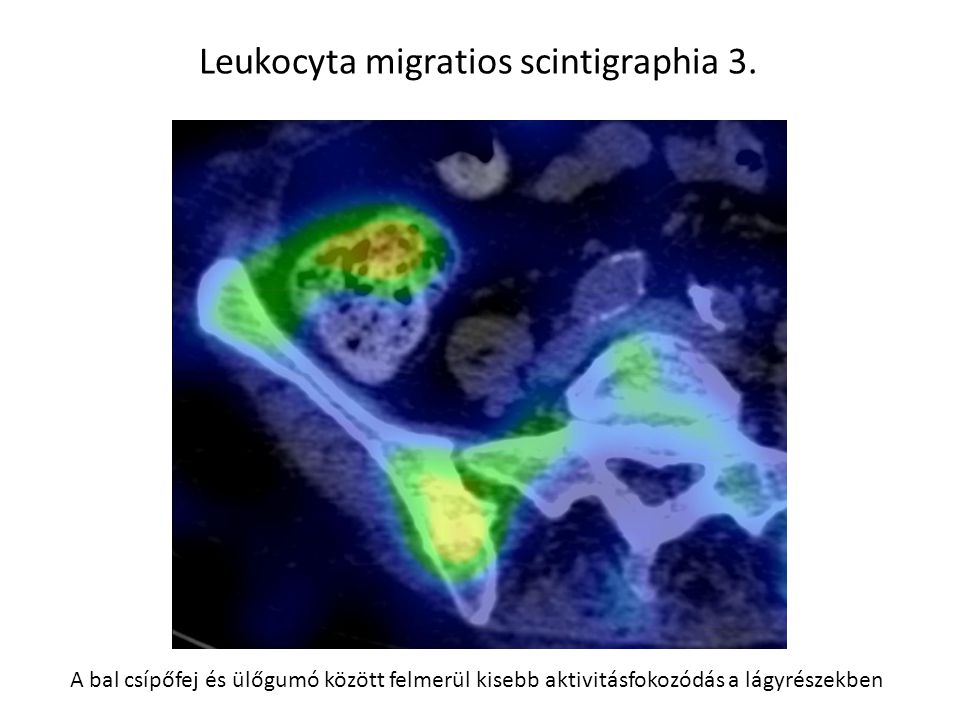 Leukocyta migratios scintigraphia 3.