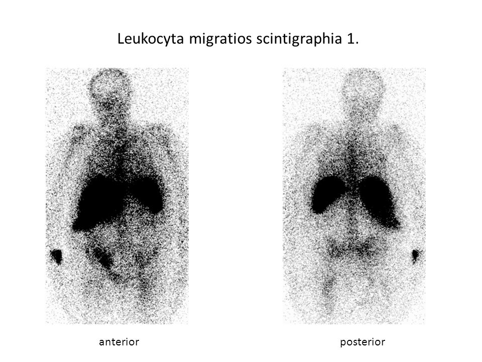 Leukocyta migratios scintigraphia 1.