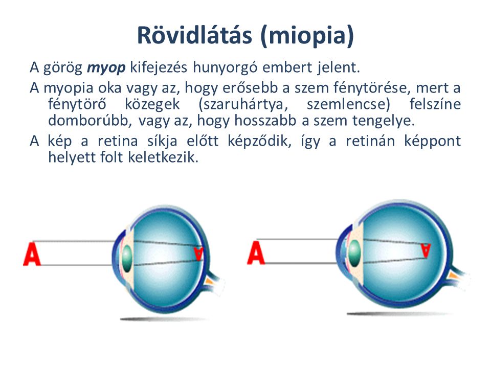 Rövidlátás (miopia)