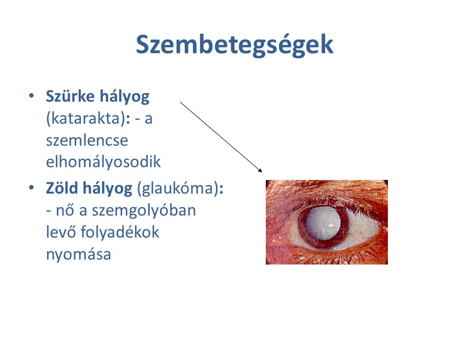 Szembetegségek Szürke hályog (katarakta): - a szemlencse elhomályosodik.
