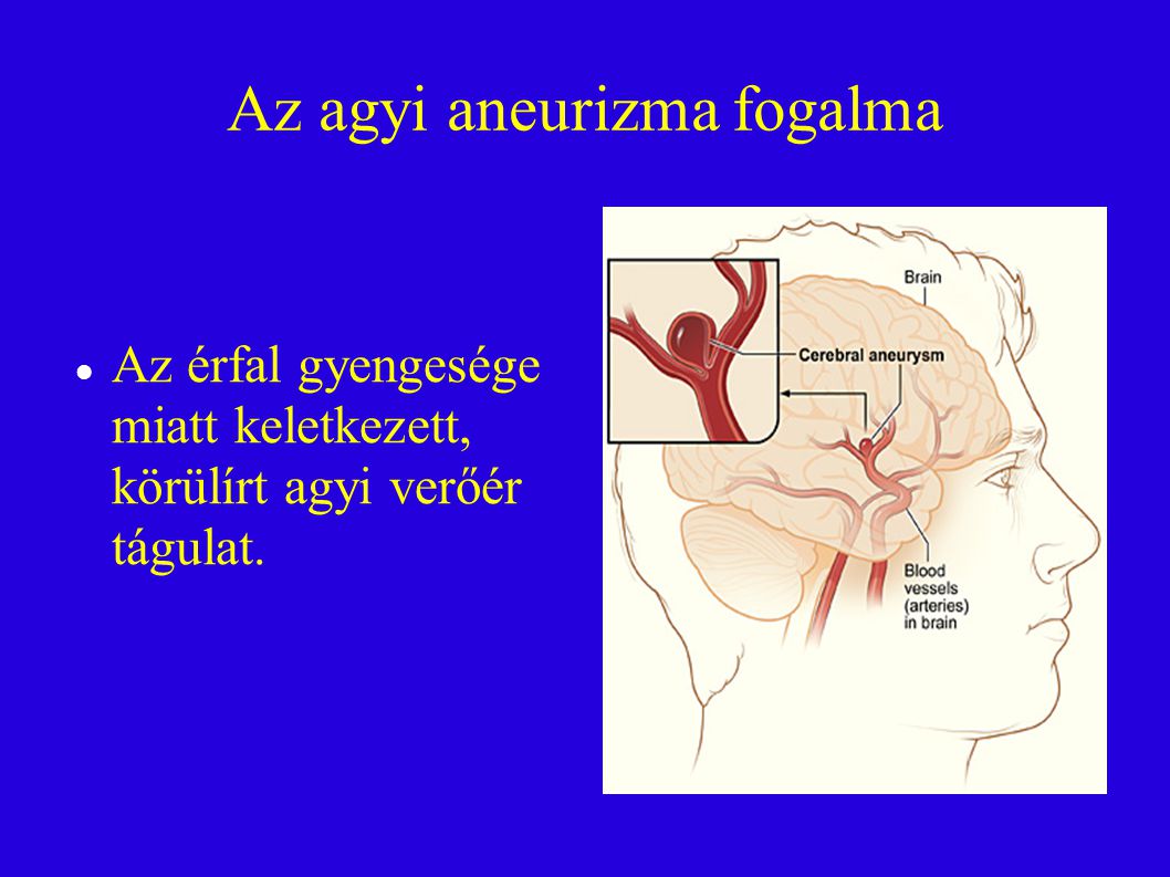 Az agyi aneurizma fogalma