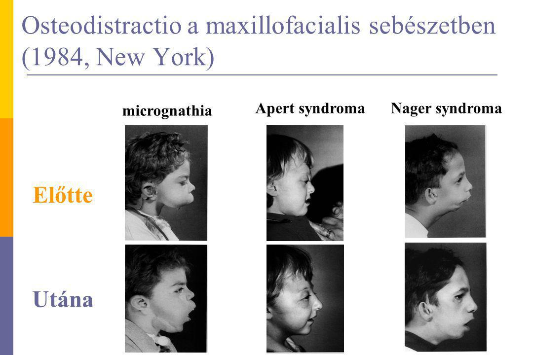 Osteodistractio a maxillofacialis sebészetben (1984, New York)