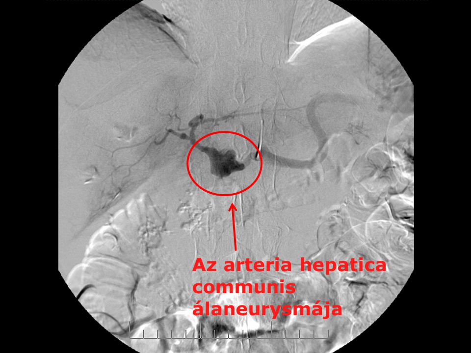 Az arteria hepatica communis álaneurysmája