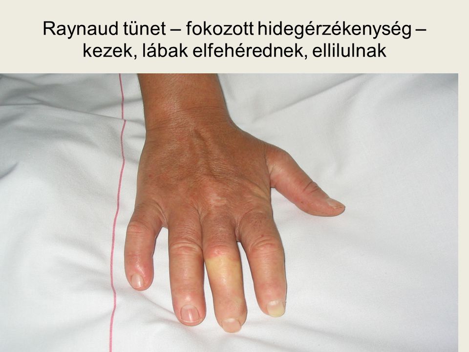 Raynaud tünet – fokozott hidegérzékenység – kezek, lábak elfehérednek, ellilulnak