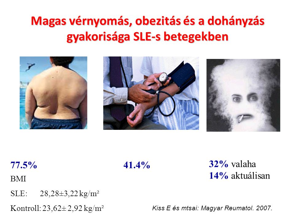 Magas vérnyomás, obezitás és a dohányzás gyakorisága SLE-s betegekben