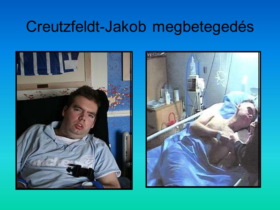 Creutzfeldt-Jakob megbetegedés