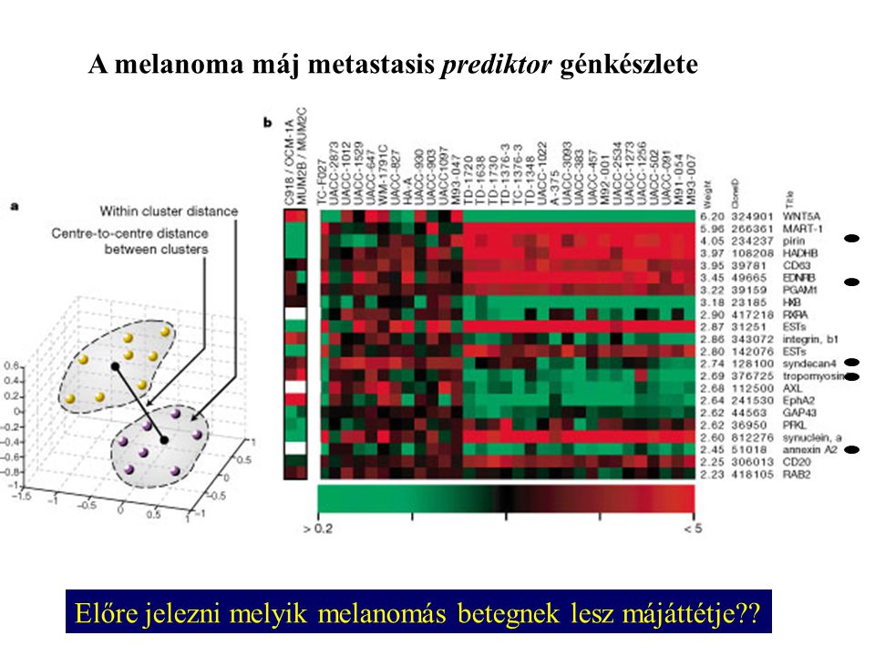 A melanoma máj metastasis prediktor génkészlete