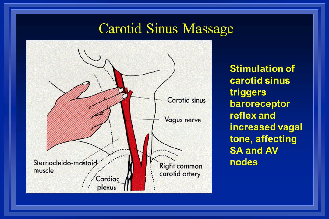 Carotid Sinus Massage Stimulation of carotid sinus triggers