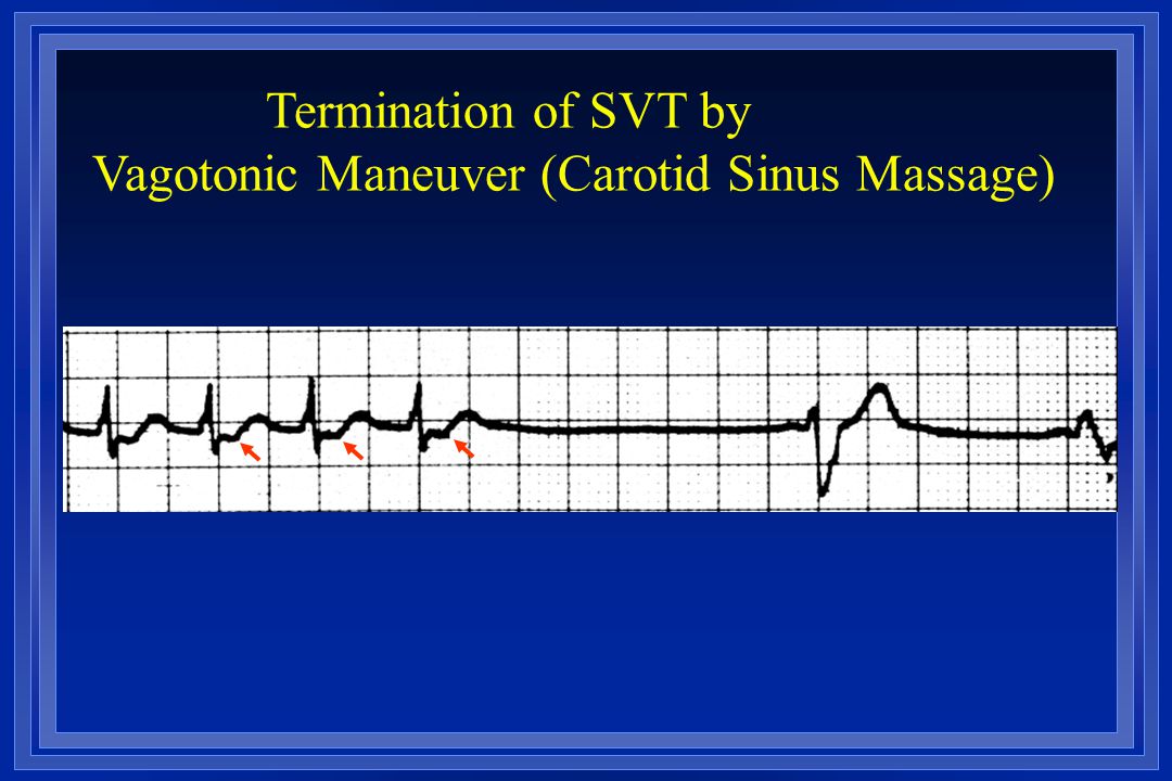 Vagotonic Maneuver (Carotid Sinus Massage)