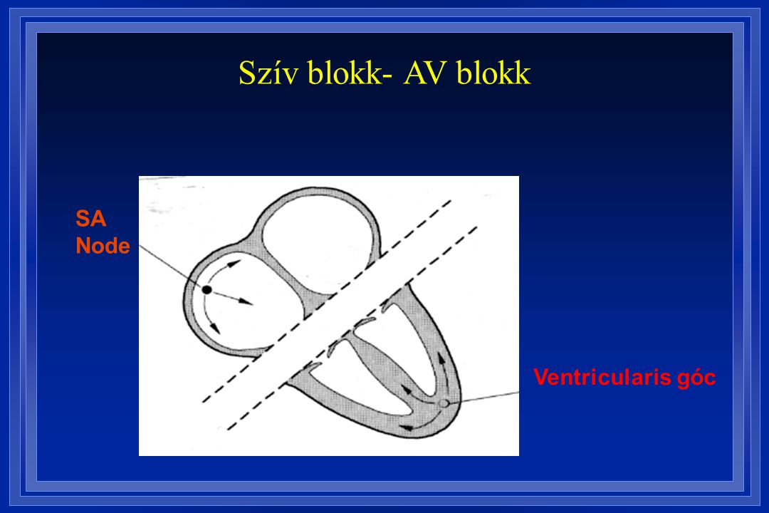 Szív blokk- AV blokk SA Node Ventricularis góc