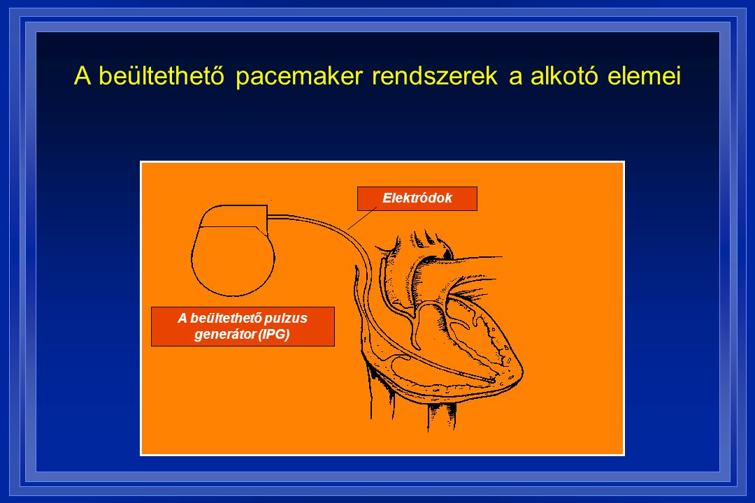 A beültethető pacemaker rendszerek a alkotó elemei