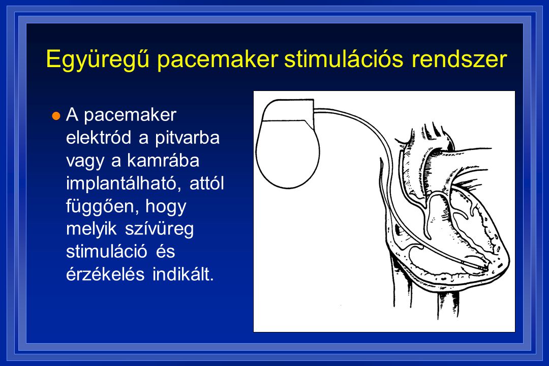 Együregű pacemaker stimulációs rendszer