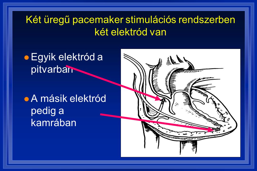 Két üregű pacemaker stimulációs rendszerben két elektród van
