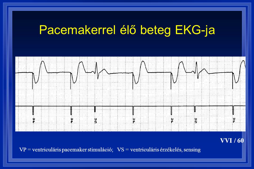 Pacemakerrel élő beteg EKG-ja